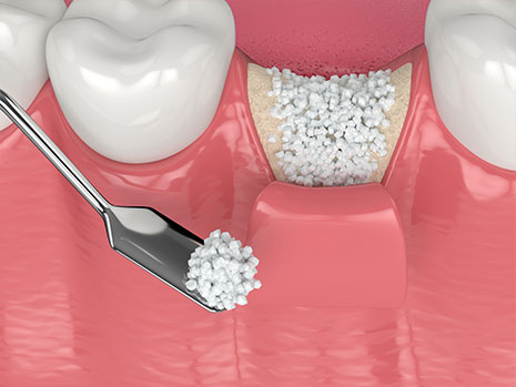 bone grafts and ridge augmentation