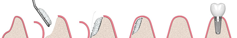 bone grafts and ridge augmentation