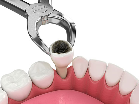 dental extractions