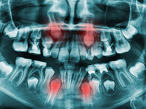 impacted canines