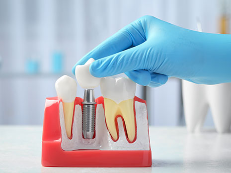 implant restoration