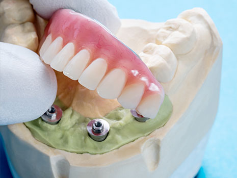 implant supported dentures