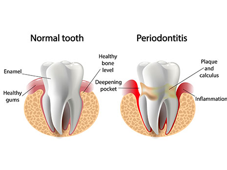 periodontal treatment options