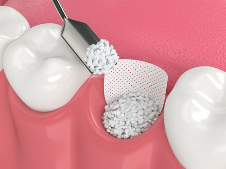 socket preservation