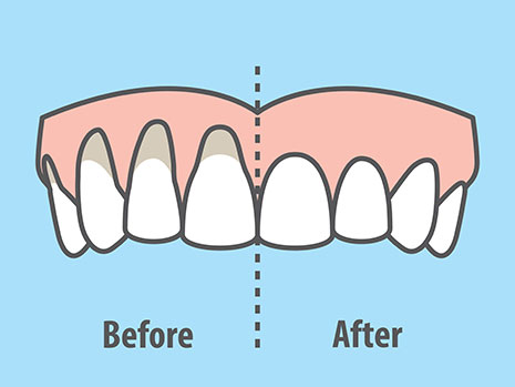 soft tissue grafting